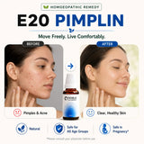 Pimples & Acne Care Kit | E20 Pimplin | Noble Life Energy