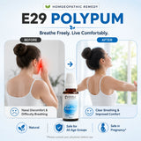 Nasal Polyp Care Kit | E29 Polypum | Noble Life Energy