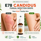 Fungal Infection Care Kit | E78 Candidus | Noble Life Energy