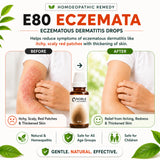 Eczema Care Kit | E80 Eczemata | Noble Life Energy