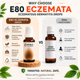 Eczema Care Kit | E80 Eczemata | Noble Life Energy