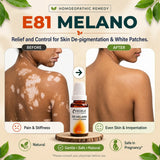 Vitiligo Care Kit | E81 Melano | Noble Life Energy
