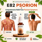 Psoriasis Care Kit | E82 Psorion | Noble Life Energy