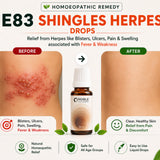 Herpes Care Kit | E83 Shingles | Noble Life Energy